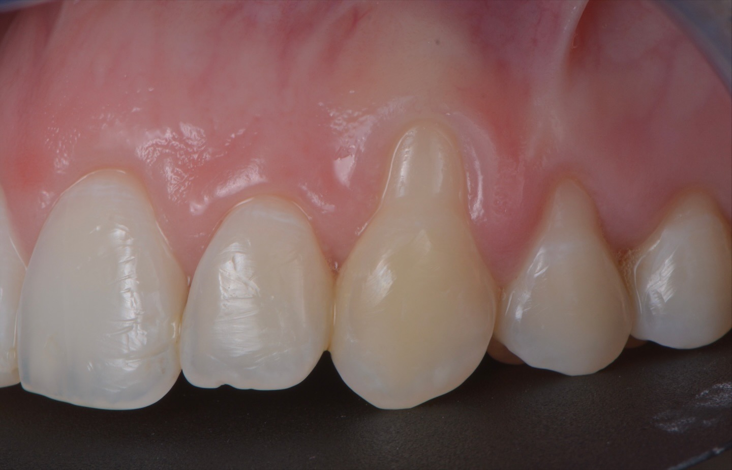 2 años de seguimiento tras cirugia mucogingival de cubrimiento radicular mediante un avance coronal del colgajo en conjunto con un injerto de conectivo autólogo del paladar