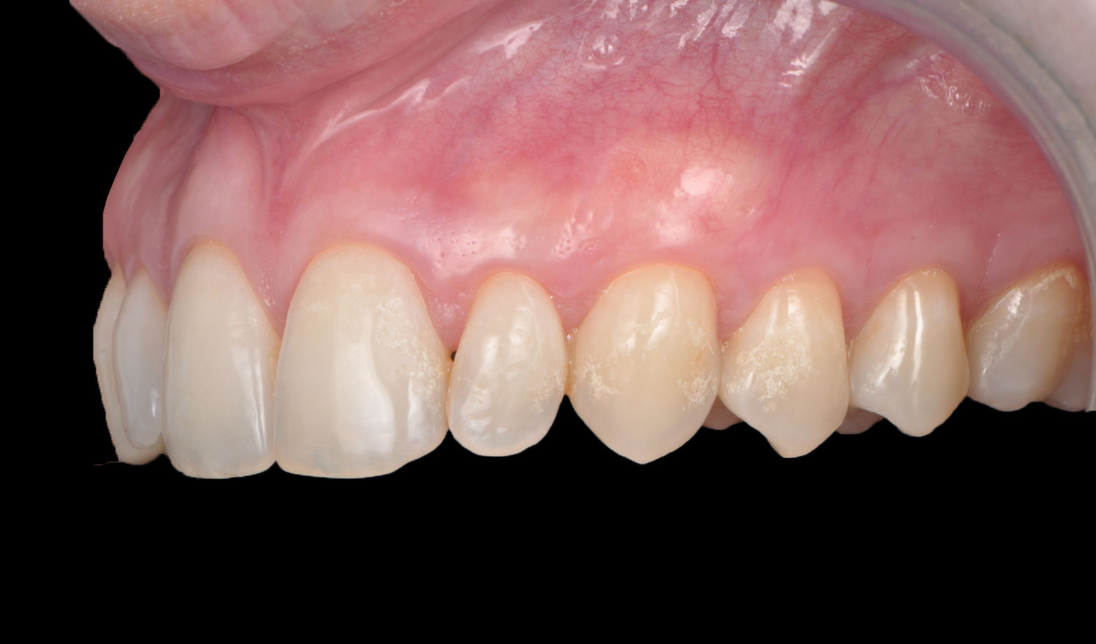 l5